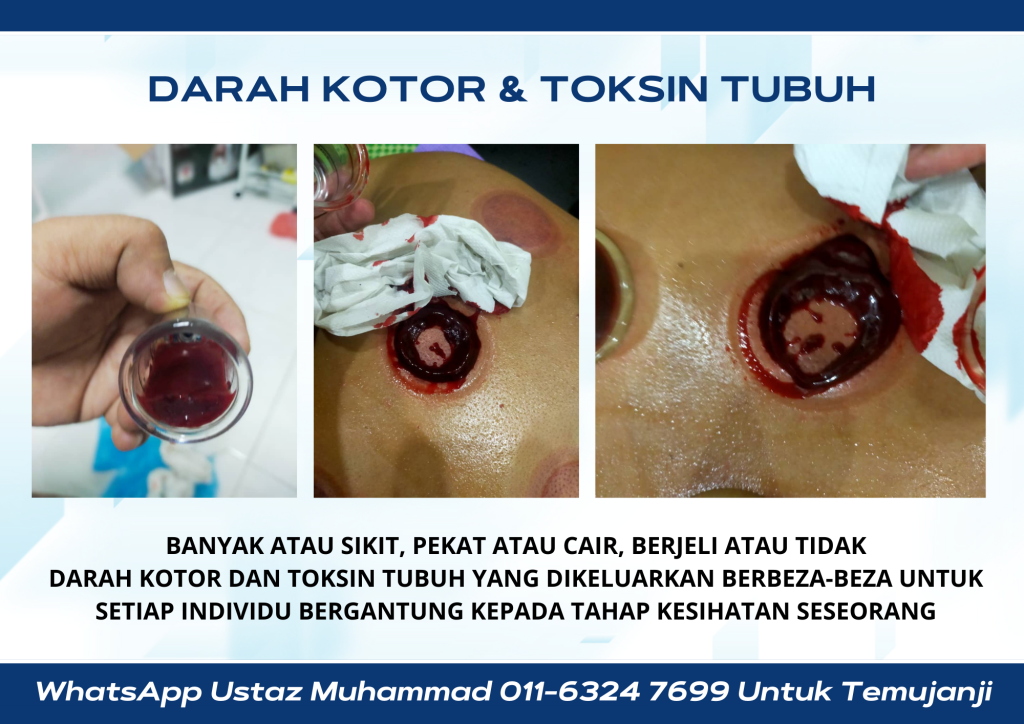 khidmat rawatan bekam pusat rawatan perubatan islam ruqyah masalah gangguan makhluk halus mistik jin saka sihir yang boleh dipercayai di bukit indah